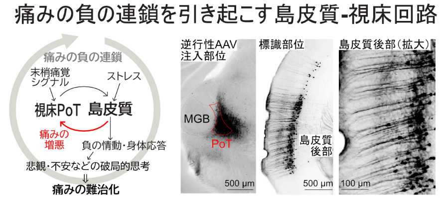 【図】 痛みの負の連鎖を引き起こす島皮質-視床回路